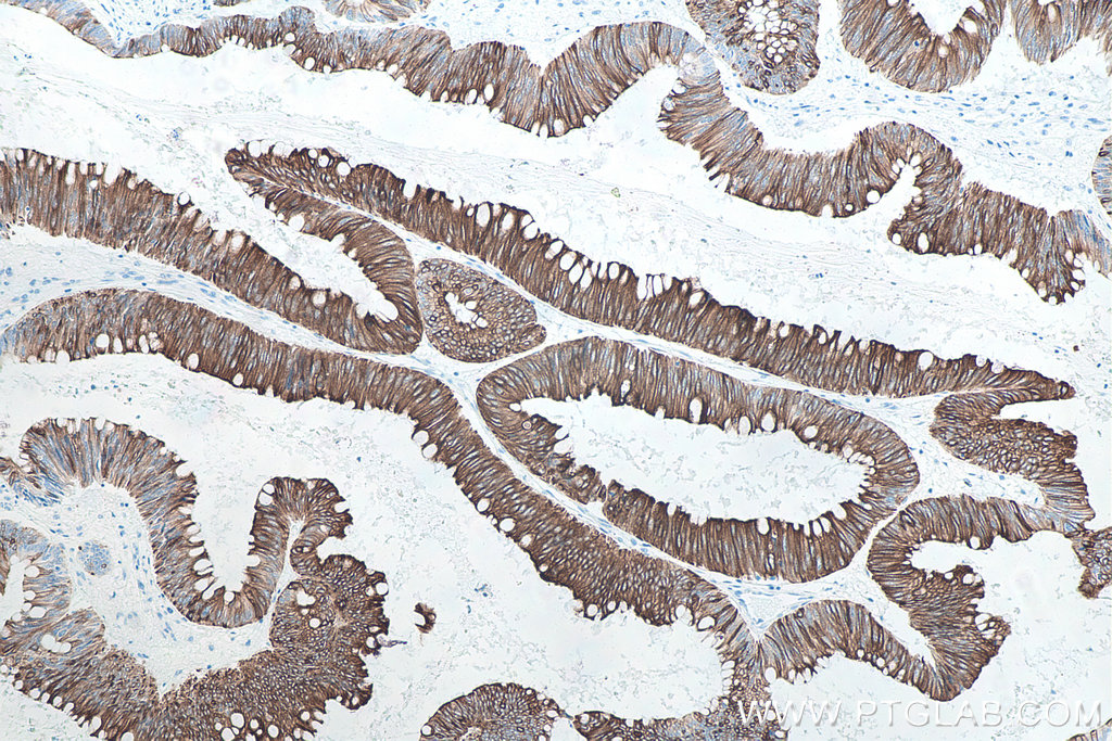 Immunohistochemistry (IHC) staining of human colon cancer tissue using Cytokeratin 20 Monoclonal antibody (60183-1-Ig)