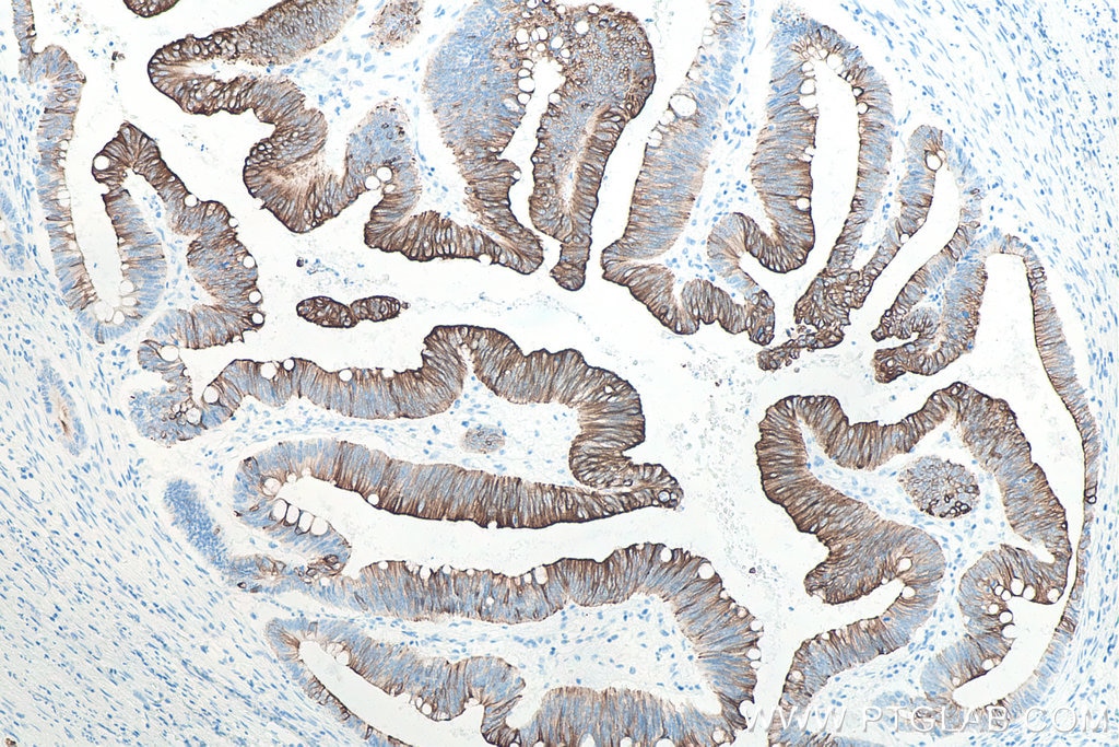 Immunohistochemistry (IHC) staining of human colon cancer tissue using Cytokeratin 20 Monoclonal antibody (60183-1-Ig)