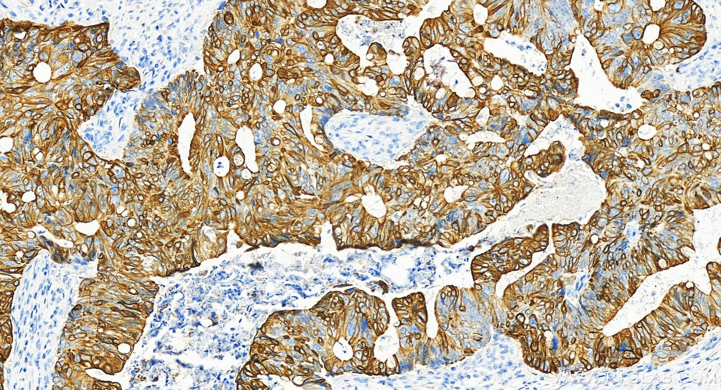 Immunohistochemistry (IHC) staining of human colon cancer tissue using Cytokeratin 20 Recombinant antibody (82428-1-RR)