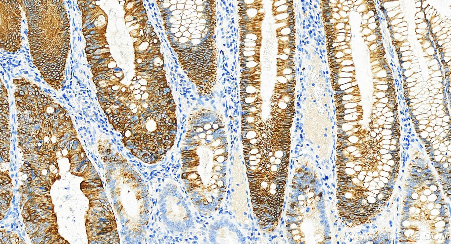 Immunohistochemistry (IHC) staining of human colon cancer tissue using Cytokeratin 20 Recombinant antibody (82428-1-RR)