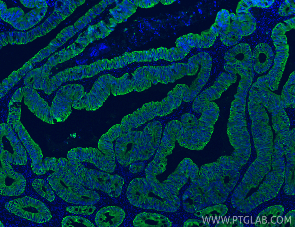 Immunofluorescence (IF) / fluorescent staining of human colon cancer tissue using Cytokeratin 20 Recombinant monoclonal antibody (82428-1-RR)