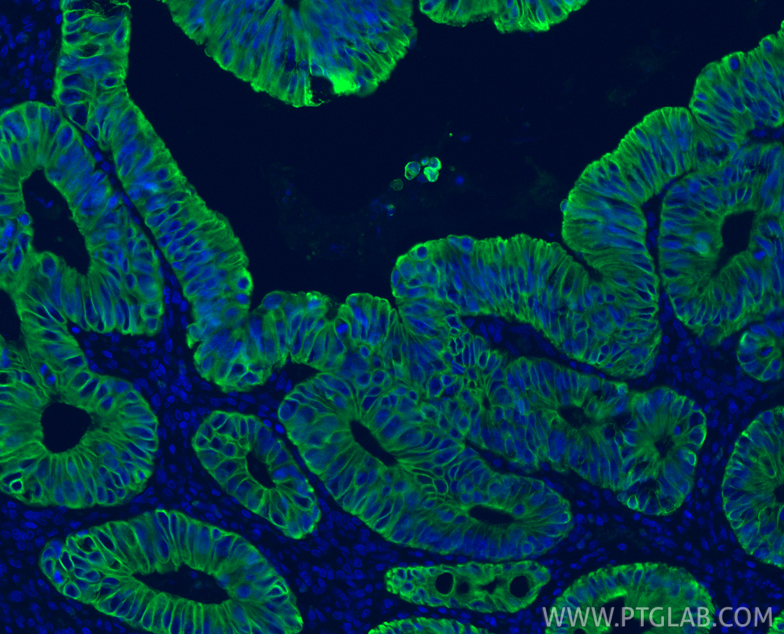 Immunofluorescence (IF) / fluorescent staining of human colon cancer tissue using Cytokeratin 20 Recombinant monoclonal antibody (82428-1-RR)