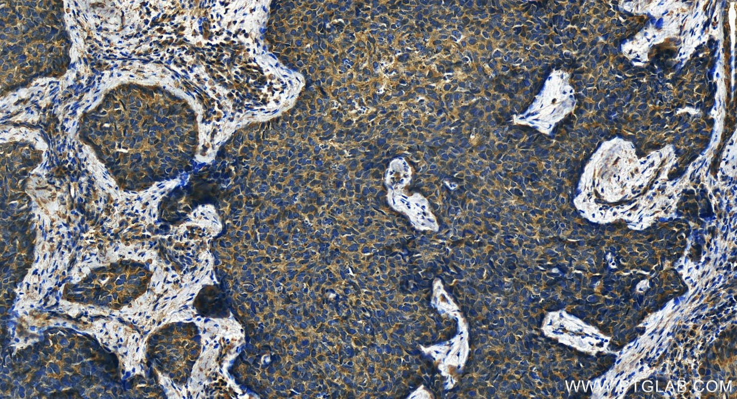 Immunohistochemistry (IHC) staining of human bowen disease using KRT23 Polyclonal antibody (24049-1-AP)