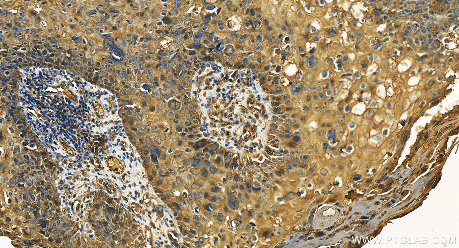 Immunohistochemistry (IHC) staining of human bowen disease using KRT23 Polyclonal antibody (24049-1-AP)