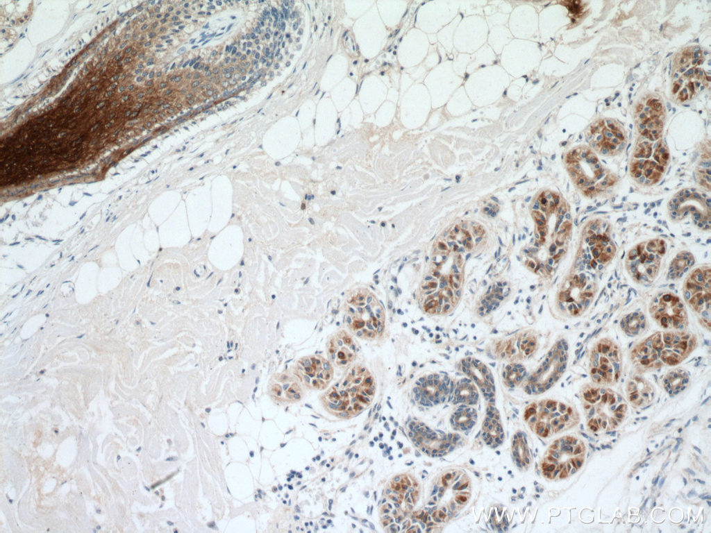 Immunohistochemistry (IHC) staining of human skin cancer tissue using KRT34 Polyclonal antibody (20449-1-AP)