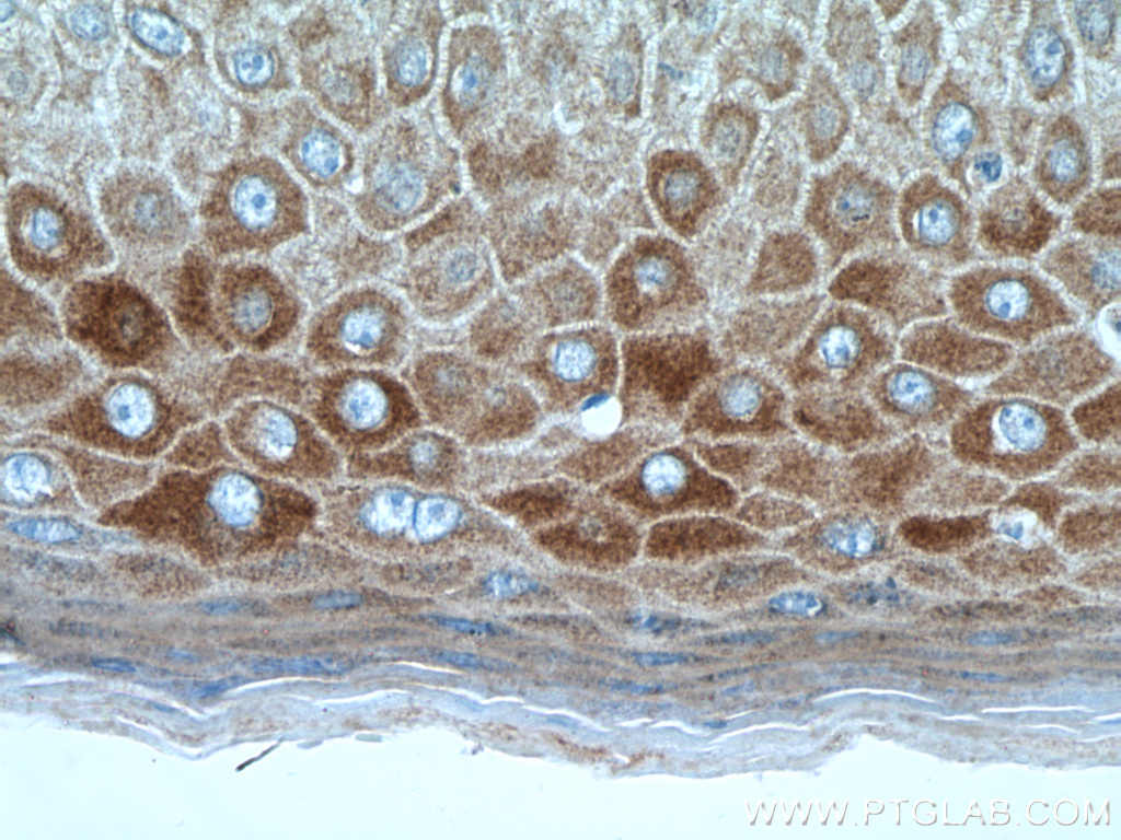 Immunohistochemistry (IHC) staining of human skin cancer tissue using KRT34 Polyclonal antibody (20449-1-AP)