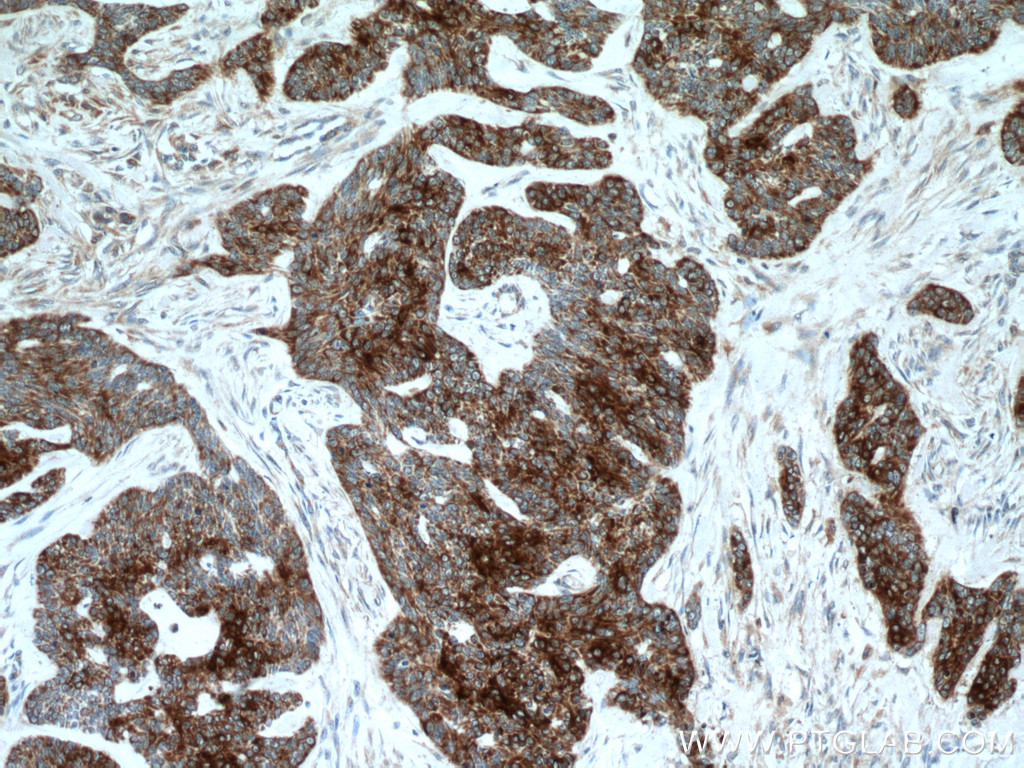 Immunohistochemistry (IHC) staining of human skin cancer tissue using KRT34 Polyclonal antibody (20449-1-AP)