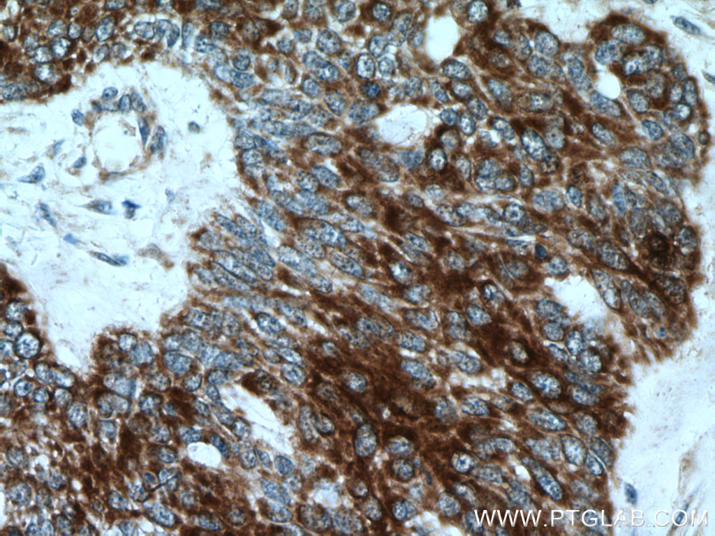 Immunohistochemistry (IHC) staining of human skin cancer tissue using KRT34 Polyclonal antibody (20449-1-AP)