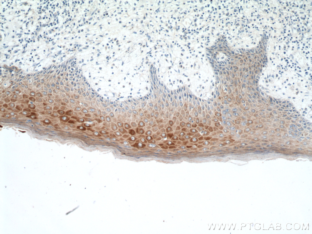 Immunohistochemistry (IHC) staining of human skin cancer tissue using KRT34 Polyclonal antibody (20449-1-AP)