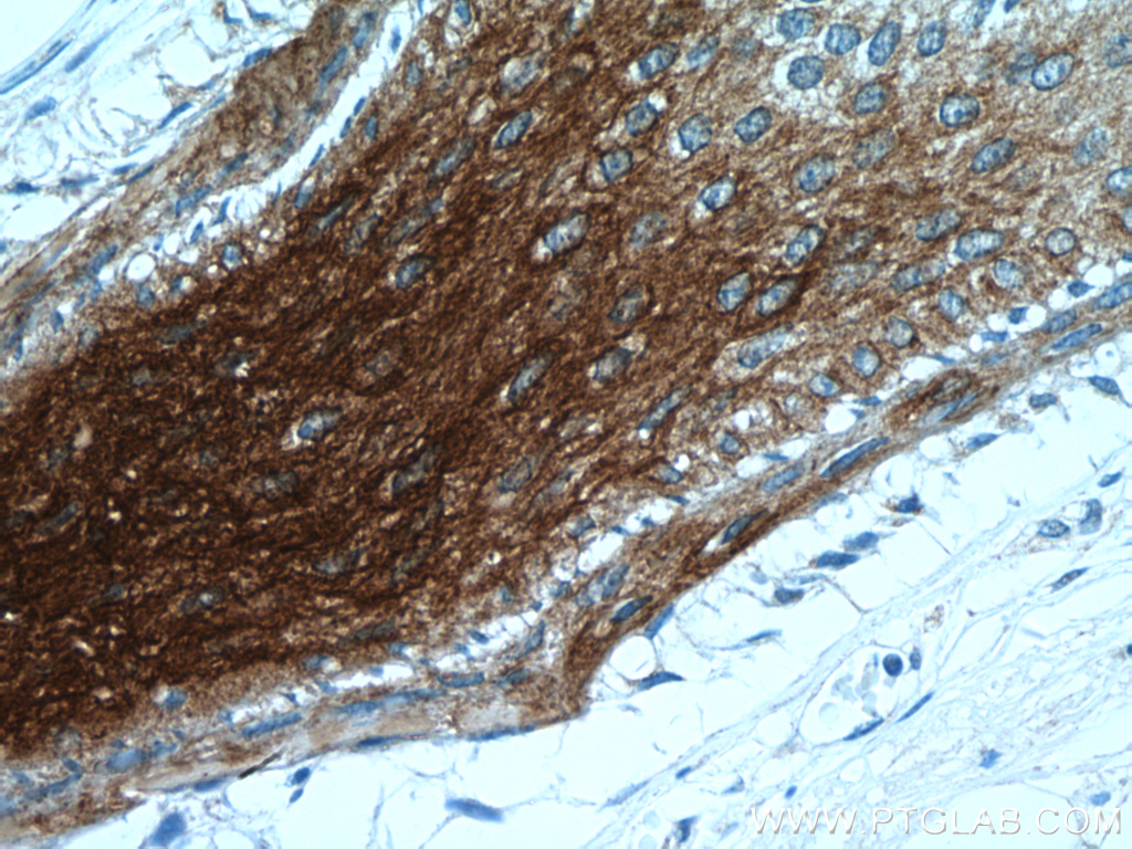 Immunohistochemistry (IHC) staining of human skin cancer tissue using KRT34 Polyclonal antibody (20449-1-AP)