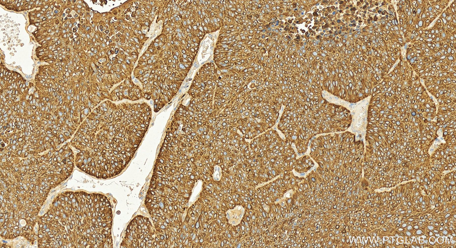 Immunohistochemistry (IHC) staining of human lung squamous cell carcinoma tissue using KRT34 Polyclonal antibody (20449-1-AP)