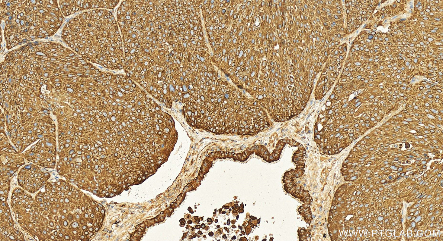 Immunohistochemistry (IHC) staining of human lung squamous cell carcinoma tissue using KRT34 Polyclonal antibody (20449-1-AP)