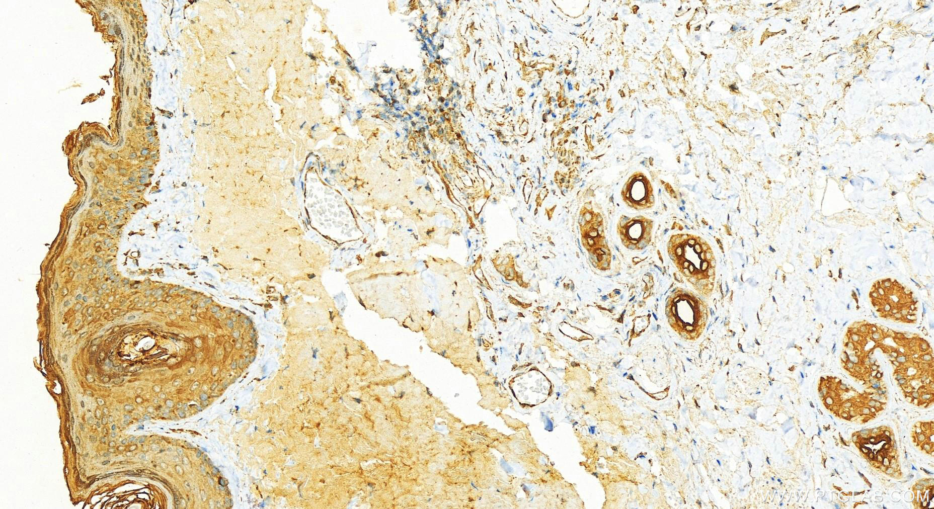 Immunohistochemistry (IHC) staining of human skin cancer tissue using Cytokeratin 6A-specific Polyclonal antibody (16853-1-AP)