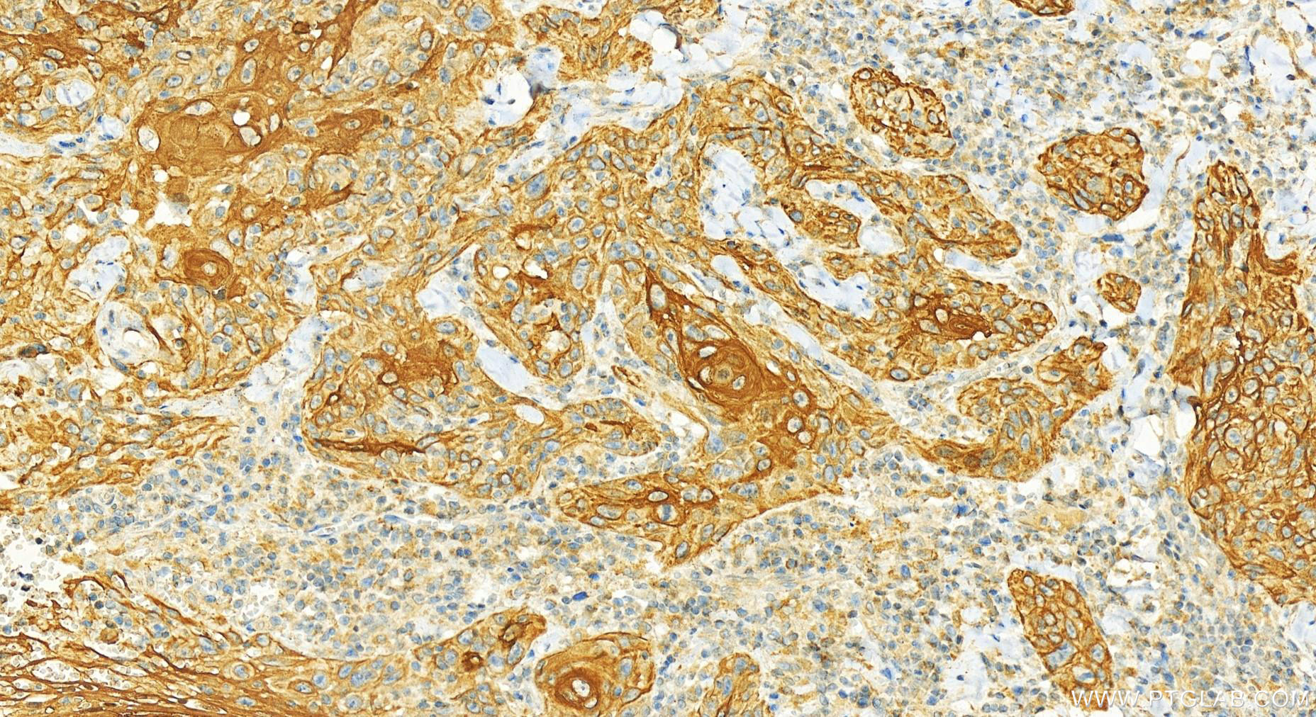 Immunohistochemistry (IHC) staining of human skin cancer tissue using Cytokeratin 6A-specific Polyclonal antibody (16853-1-AP)