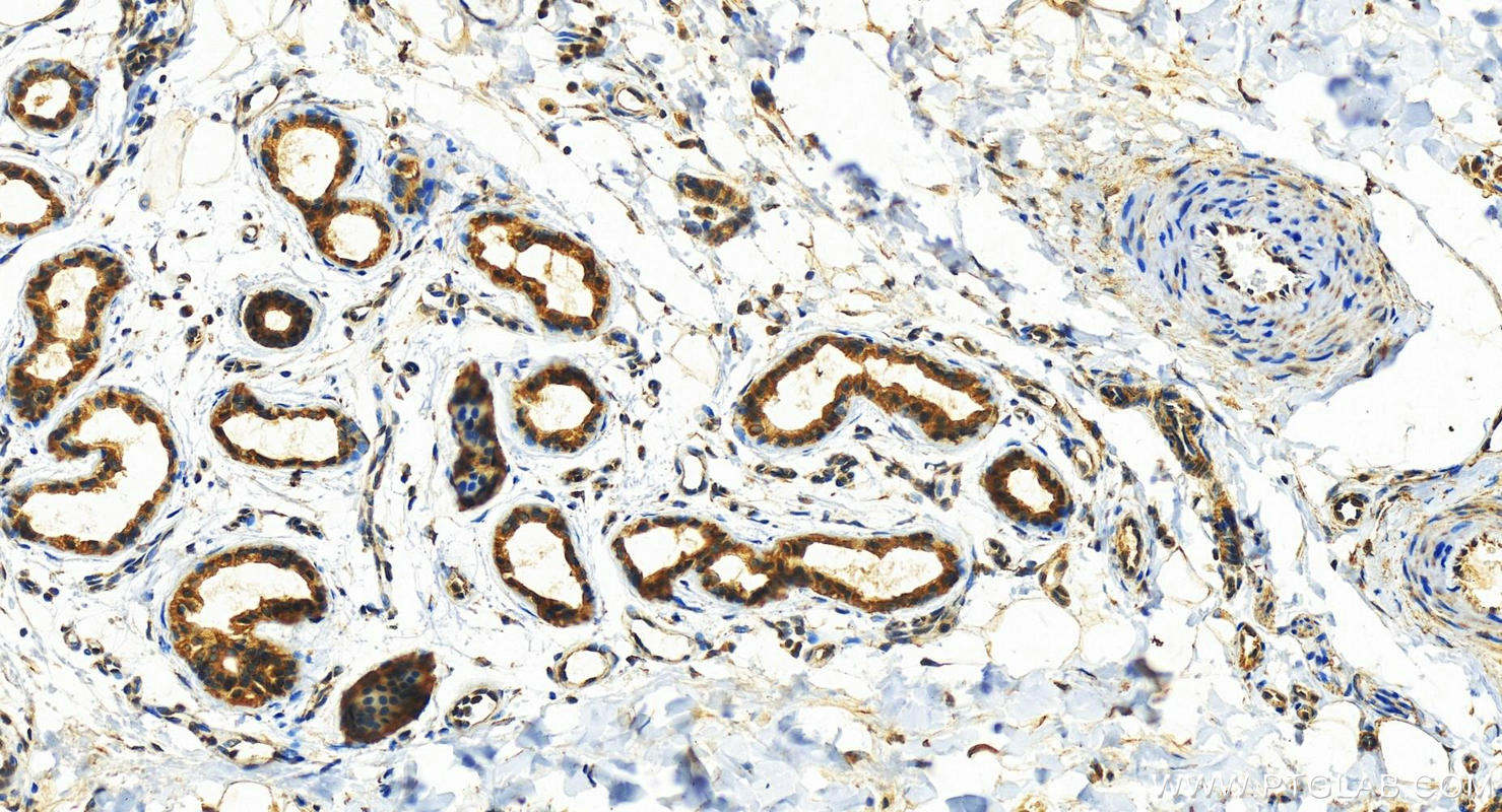 Immunohistochemistry (IHC) staining of human bowen disease using Cytokeratin 6A-specific Polyclonal antibody (16853-1-AP)