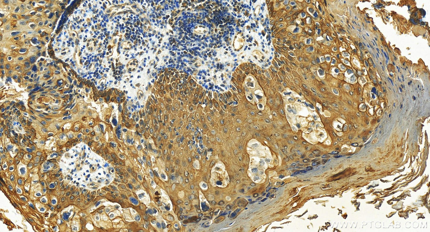 Immunohistochemistry (IHC) staining of human bowen disease using Cytokeratin 6A-specific Polyclonal antibody (16853-1-AP)