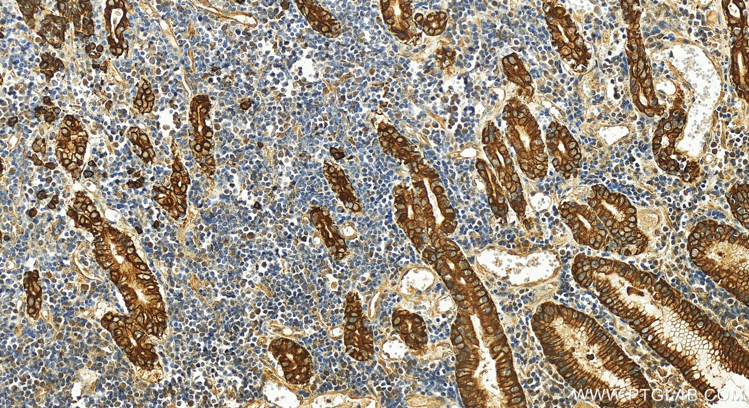 Immunohistochemistry (IHC) staining of human stomach cancer tissue using Cytokeratin 7 Polyclonal antibody (15539-1-AP)