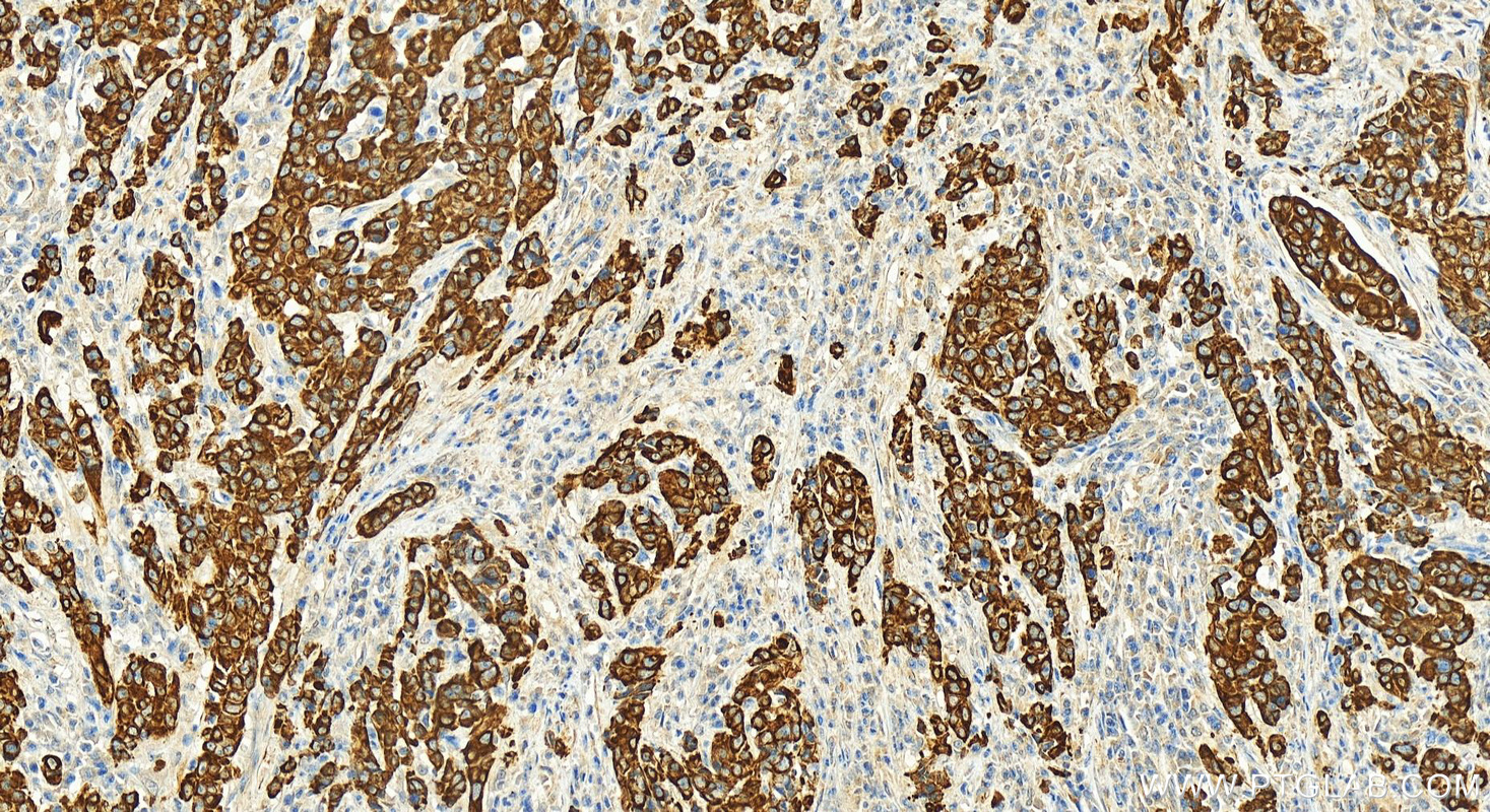 Immunohistochemistry (IHC) staining of human stomach cancer tissue using Cytokeratin 7 Polyclonal antibody (15539-1-AP)