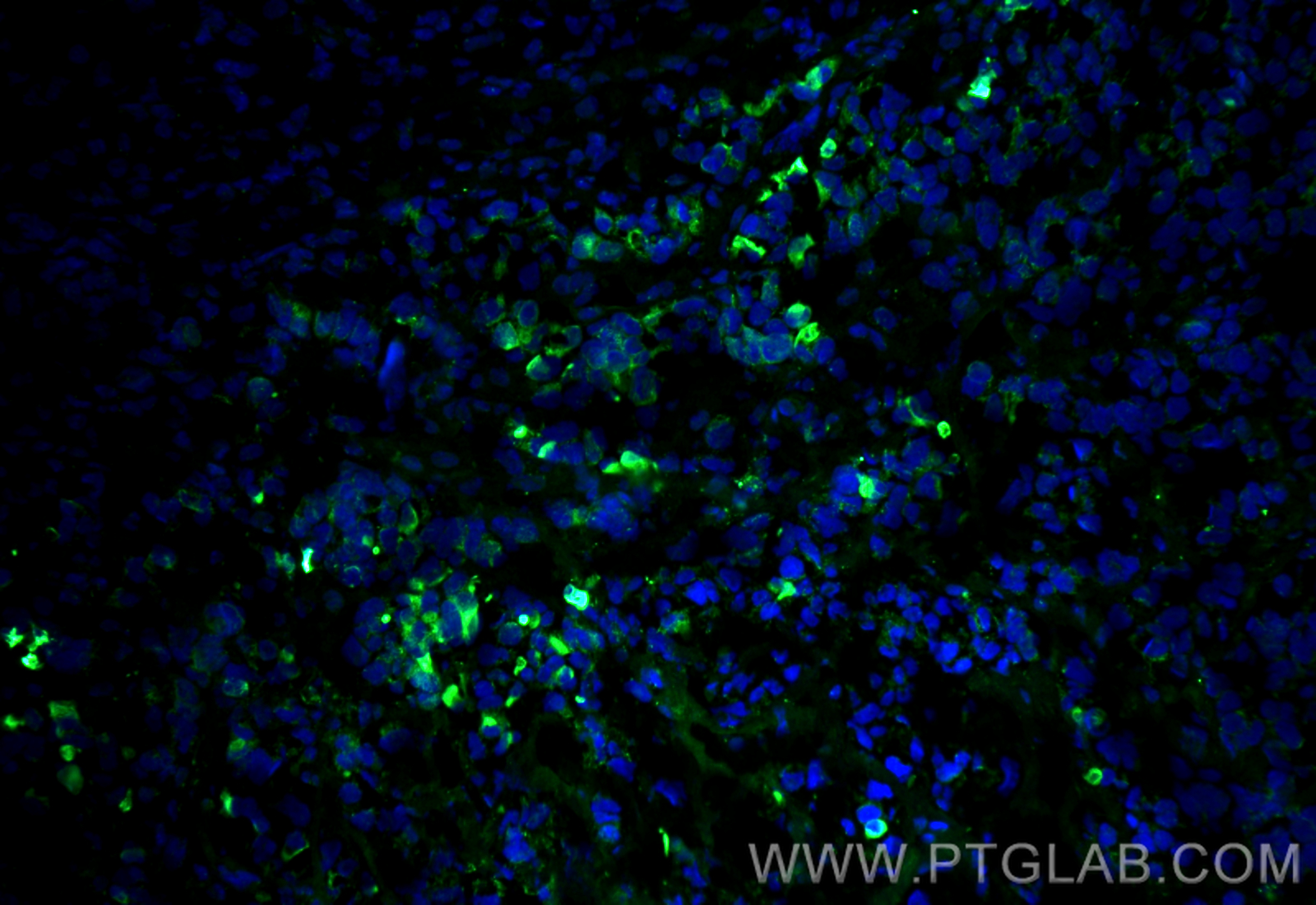 Immunofluorescence (IF) / fluorescent staining of mouse breast cancer using Cytokeratin 7 Polyclonal antibody (15539-1-AP)