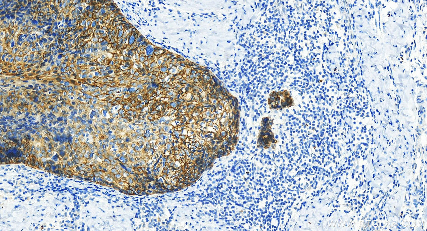 Immunohistochemistry (IHC) staining of human bowen disease using Cytokeratin 7 Polyclonal antibody (15539-1-AP)