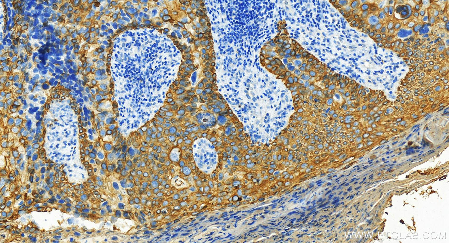 Immunohistochemistry (IHC) staining of human bowen disease using Cytokeratin 7 Polyclonal antibody (15539-1-AP)