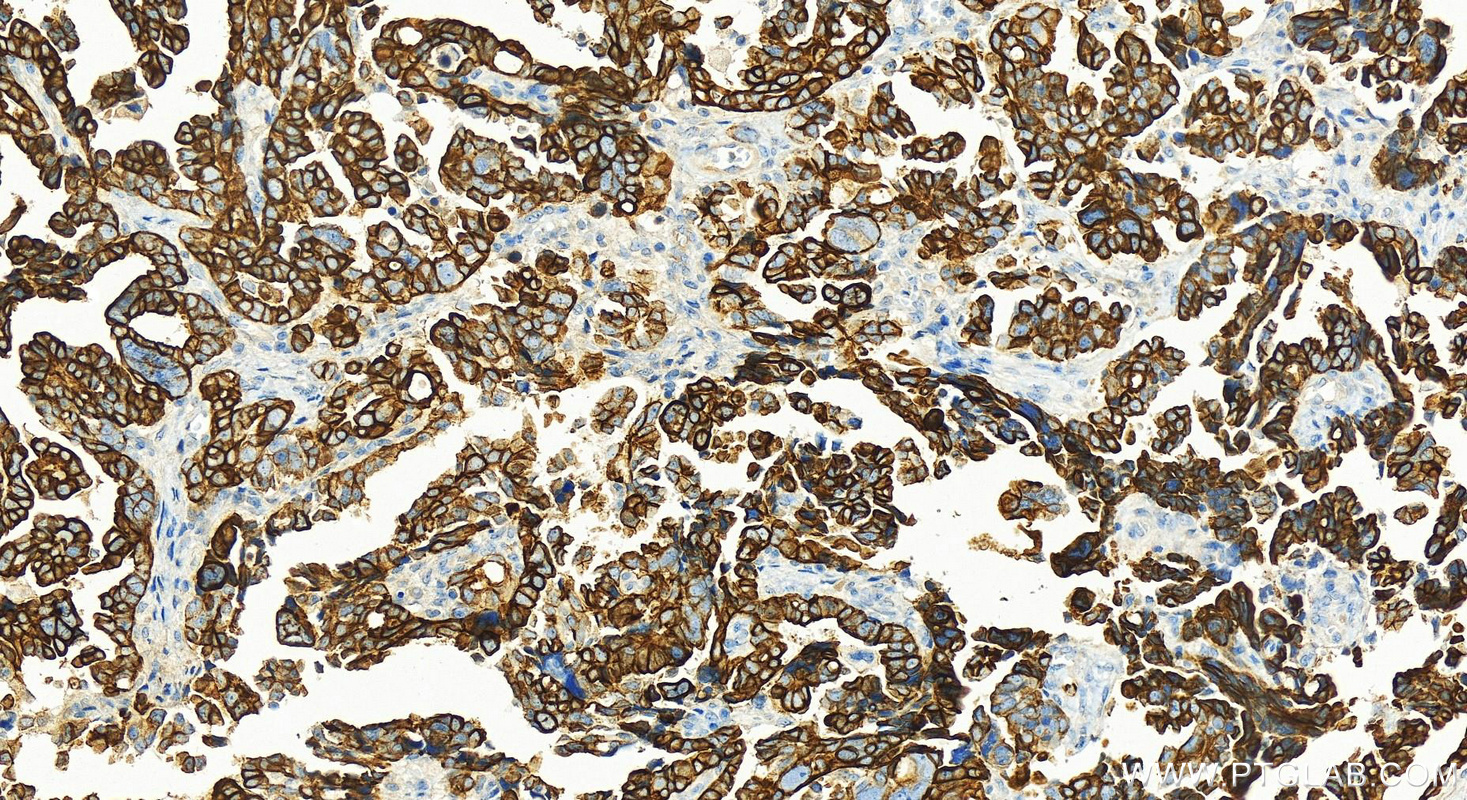 Immunohistochemistry (IHC) staining of human ovary cancer tissue using Cytokeratin 7 Polyclonal antibody (22208-1-AP)