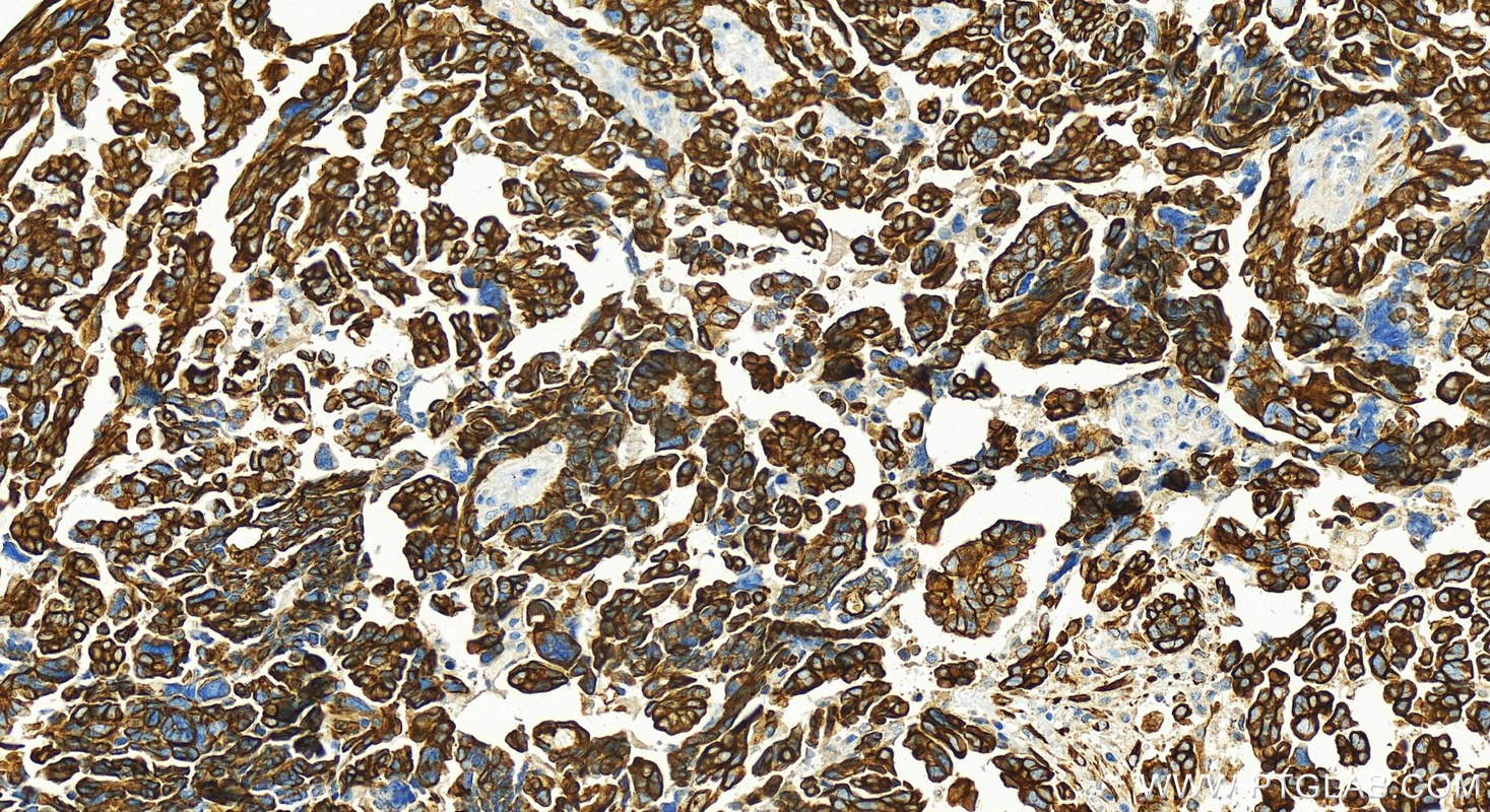 Immunohistochemistry (IHC) staining of human ovary cancer tissue using Cytokeratin 7 Polyclonal antibody (22208-1-AP)