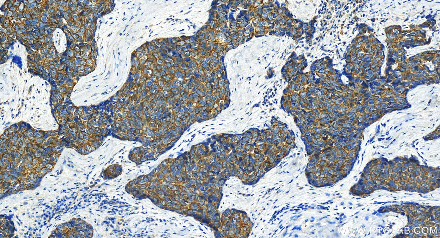 Immunohistochemistry (IHC) staining of human bowen disease using Cytokeratin 7 Polyclonal antibody (22208-1-AP)