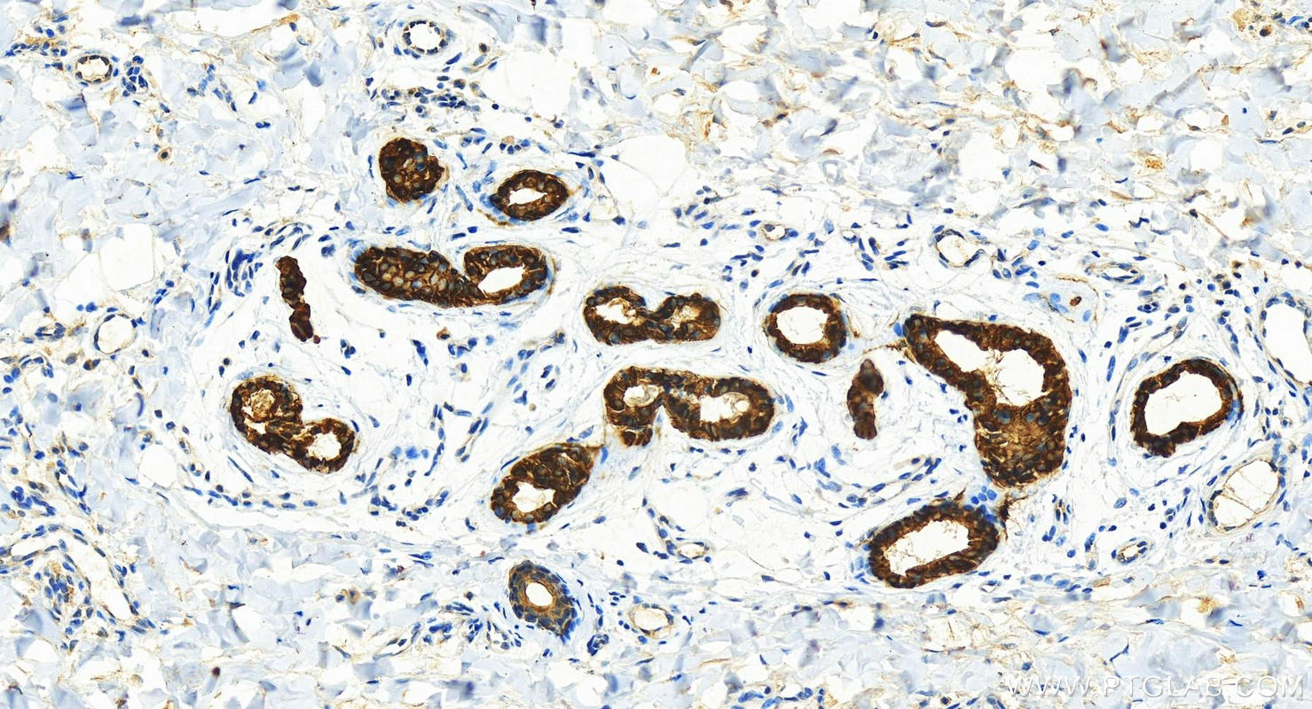 Immunohistochemistry (IHC) staining of human bowen disease using Cytokeratin 7 Polyclonal antibody (22208-1-AP)