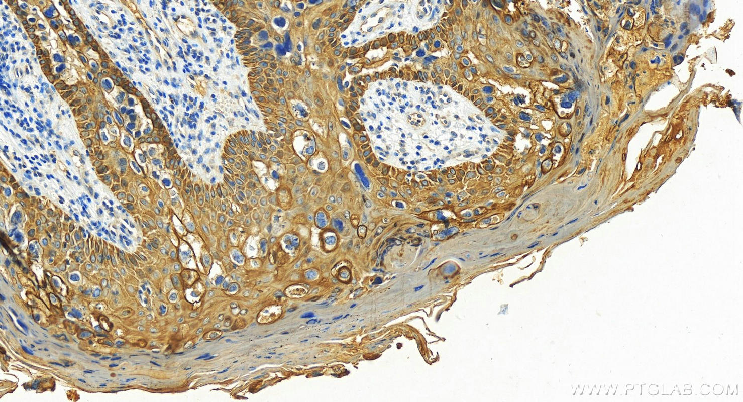 Immunohistochemistry (IHC) staining of human bowen disease using Cytokeratin 7 Polyclonal antibody (22208-1-AP)