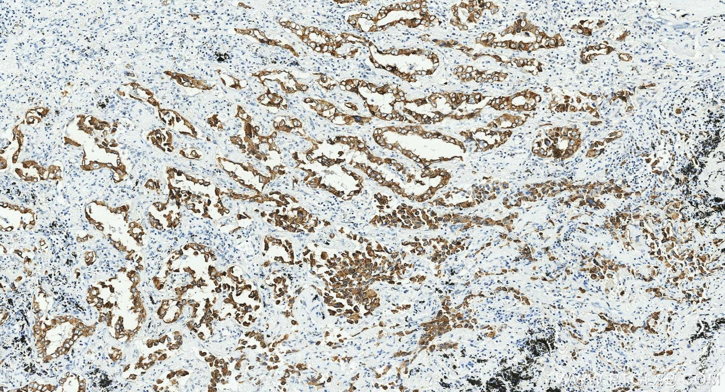 Immunohistochemistry (IHC) staining of human lung cancer tissue using Cytokeratin 7-specific Polyclonal antibody (17513-1-AP)