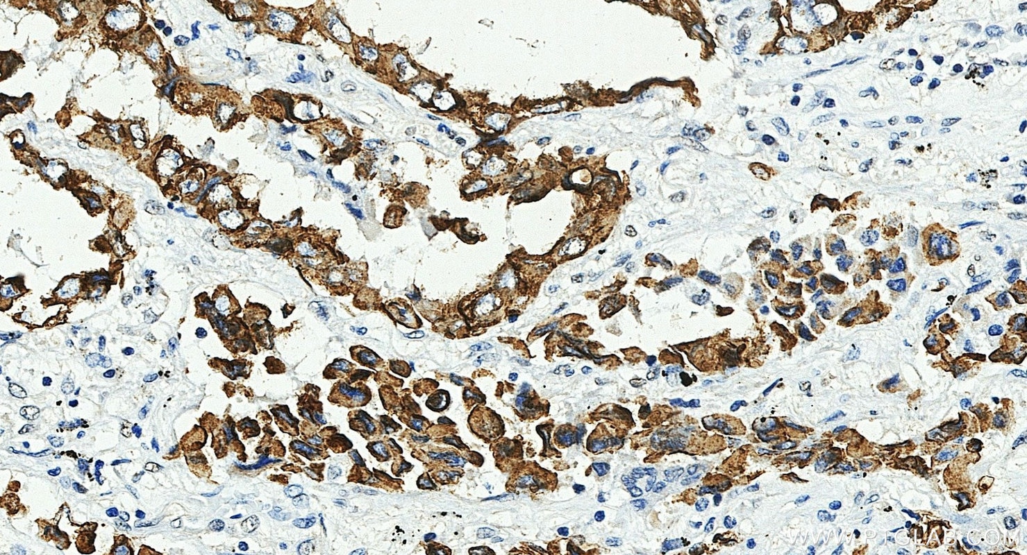 Immunohistochemistry (IHC) staining of human lung cancer tissue using Cytokeratin 7-specific Polyclonal antibody (17513-1-AP)