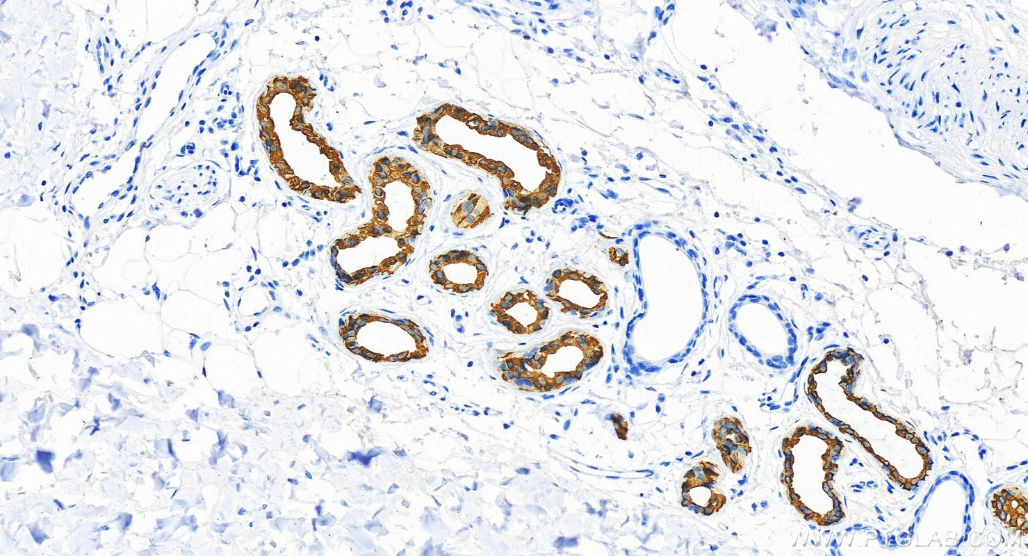 Immunohistochemistry (IHC) staining of human bowen disease using Cytokeratin 7-specific Polyclonal antibody (17513-1-AP)