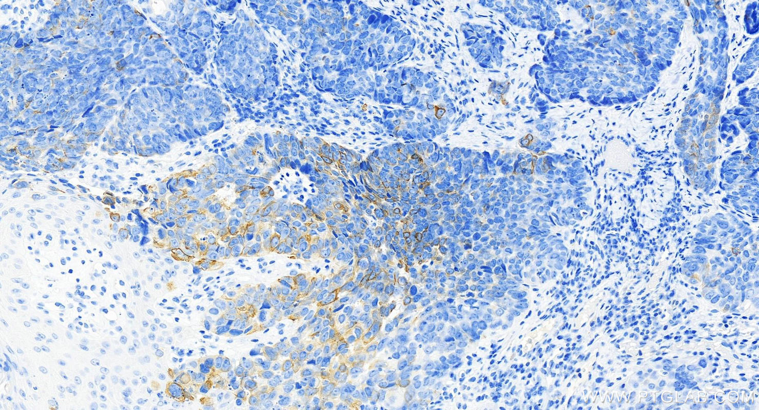 Immunohistochemistry (IHC) staining of human bowen disease using Cytokeratin 7-specific Polyclonal antibody (17513-1-AP)