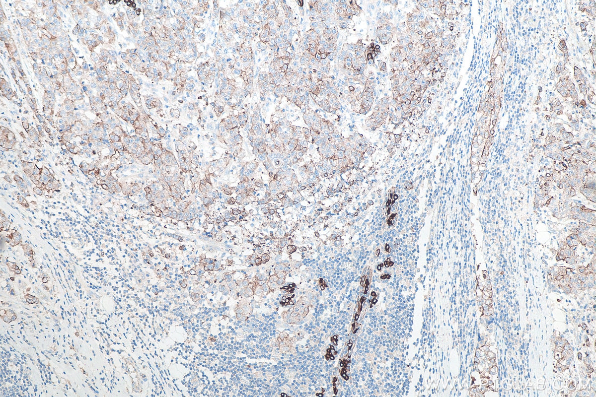 Immunohistochemistry (IHC) staining of human breast cancer tissue using Cytokeratin 8 Polyclonal antibody (10384-1-AP)