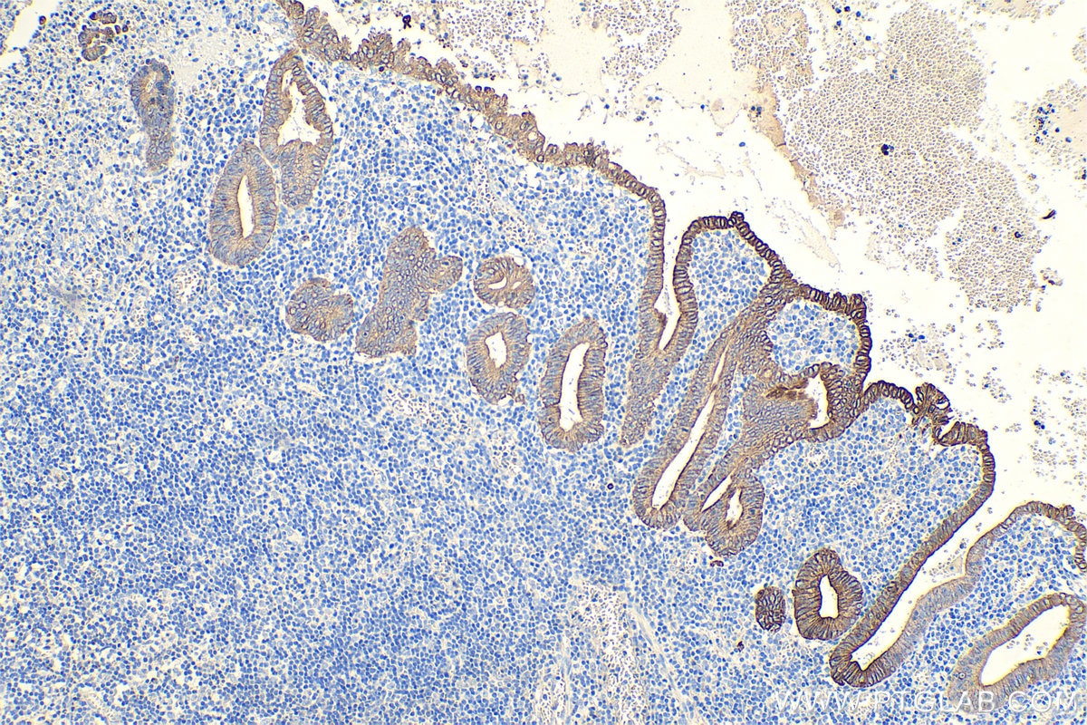 Immunohistochemistry (IHC) staining of human appendicitis tissue using Cytokeratin 8 Polyclonal antibody (10384-1-AP)