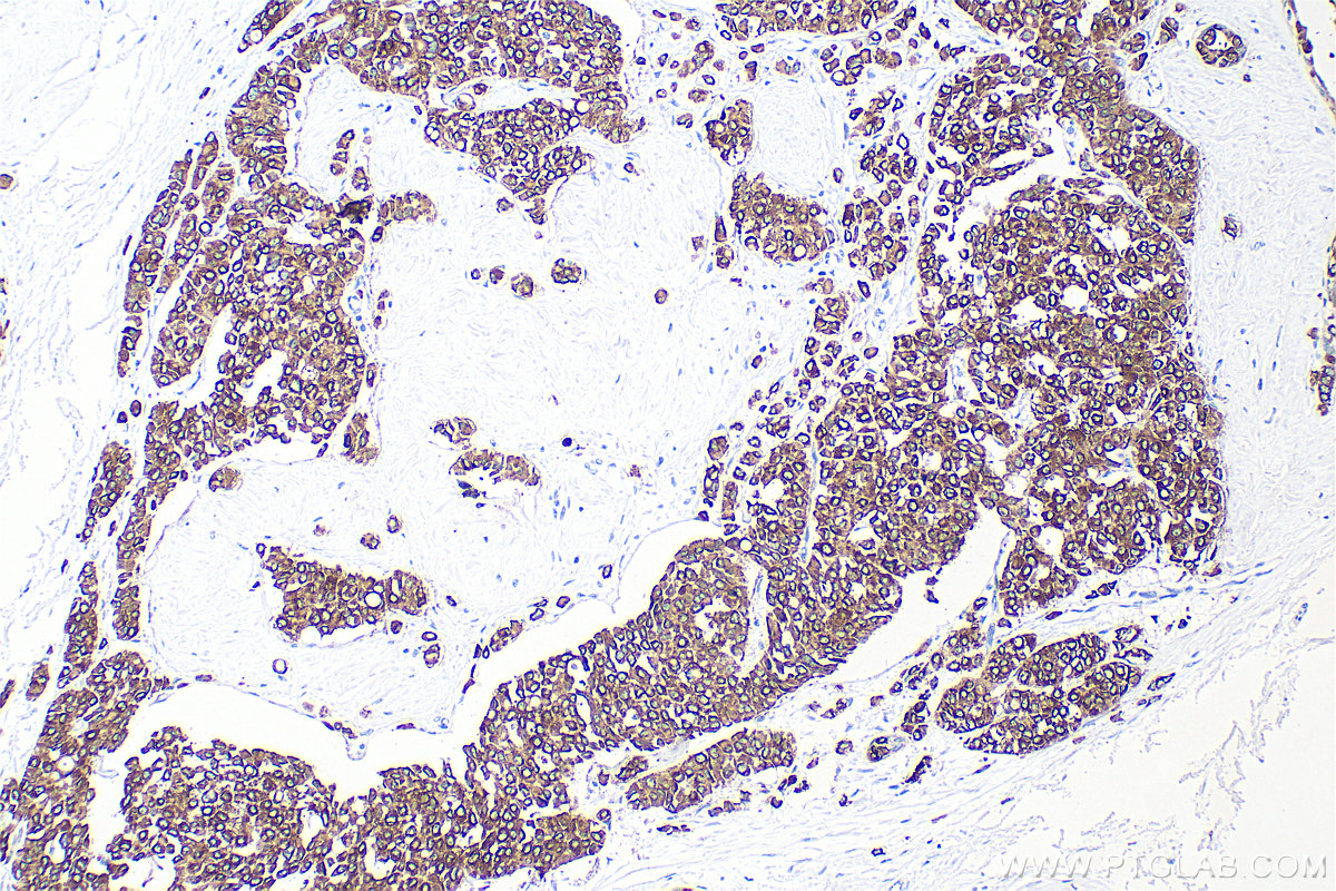 Immunohistochemistry (IHC) staining of human breast cancer tissue using Cytokeratin 8 Polyclonal antibody (10384-1-AP)