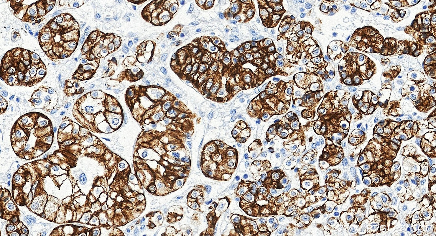 Immunohistochemistry (IHC) staining of human renal cell carcinoma tissue using Cytokeratin 8 Polyclonal antibody (10384-1-AP)