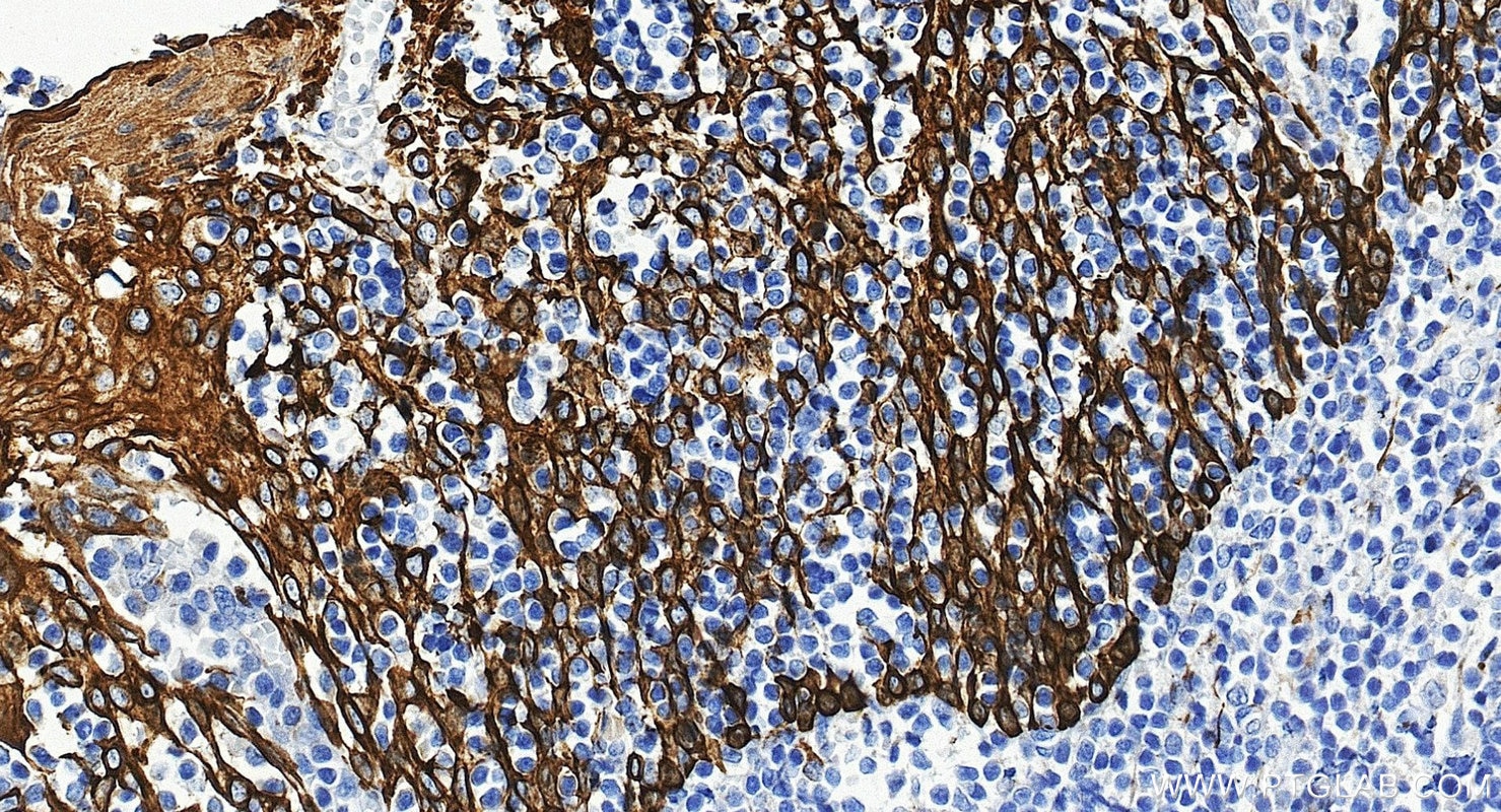 Immunohistochemistry (IHC) staining of human tonsillitis tissue using Cytokeratin 8 Polyclonal antibody (10384-1-AP)