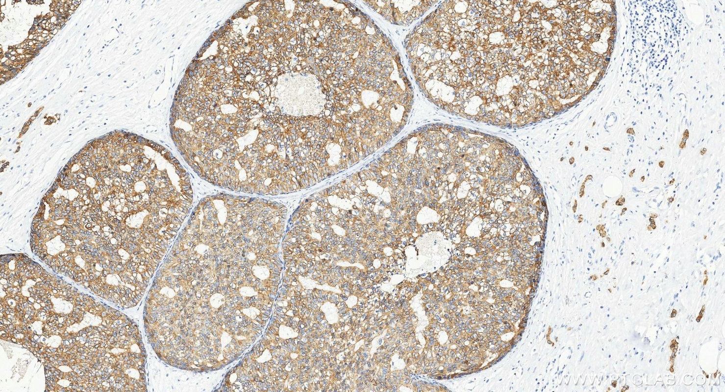 Immunohistochemistry (IHC) staining of human breast cancer tissue using Cytokeratin 8 Polyclonal antibody (10384-1-AP)