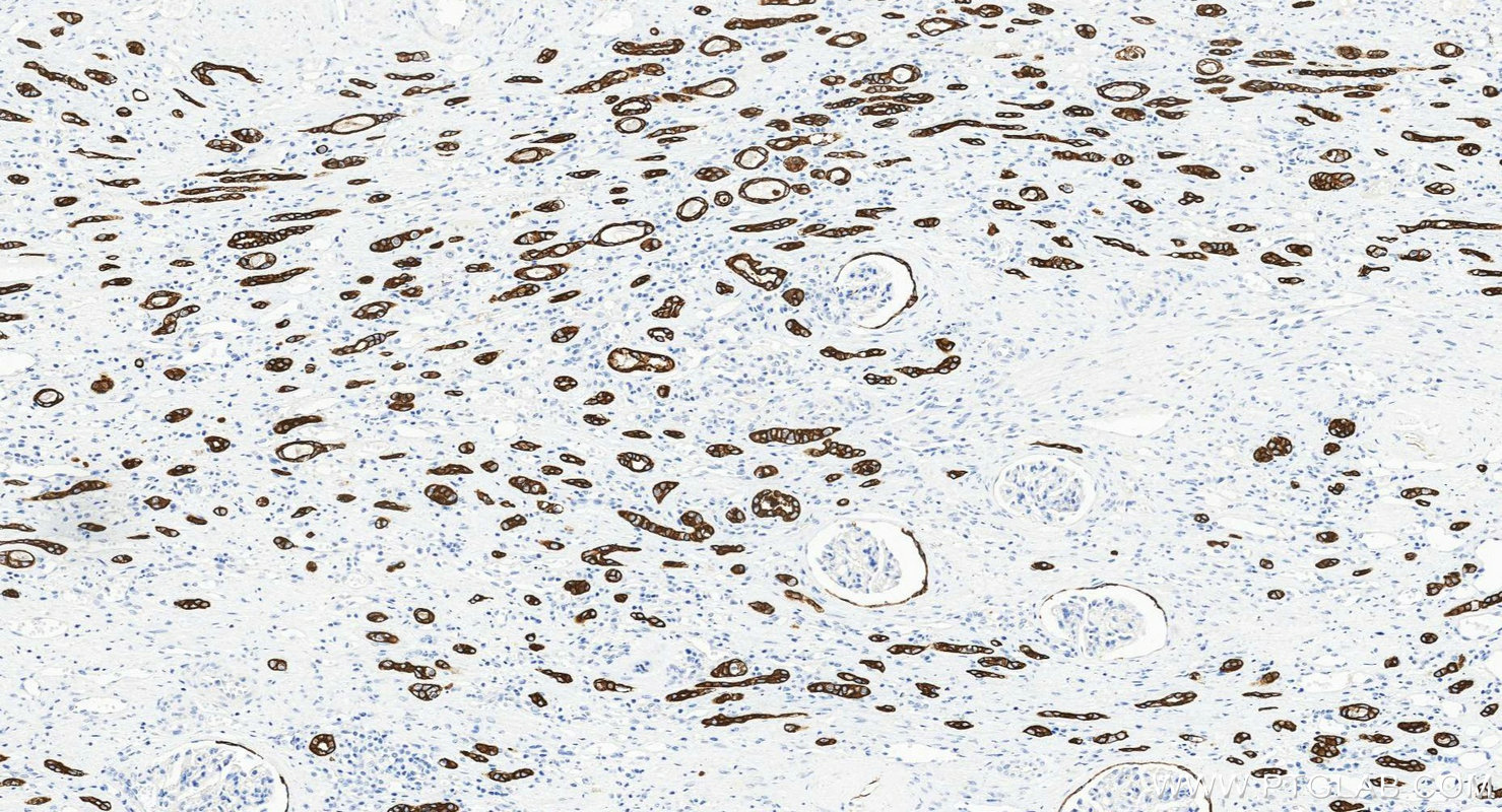 Immunohistochemistry (IHC) staining of human renal cell carcinoma tissue using Cytokeratin 8 Polyclonal antibody (10384-1-AP)
