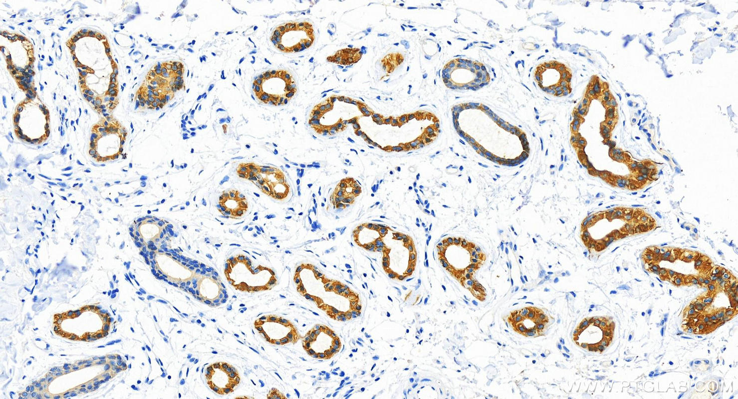 Immunohistochemistry (IHC) staining of human bowen disease using Cytokeratin 8 Polyclonal antibody (10384-1-AP)