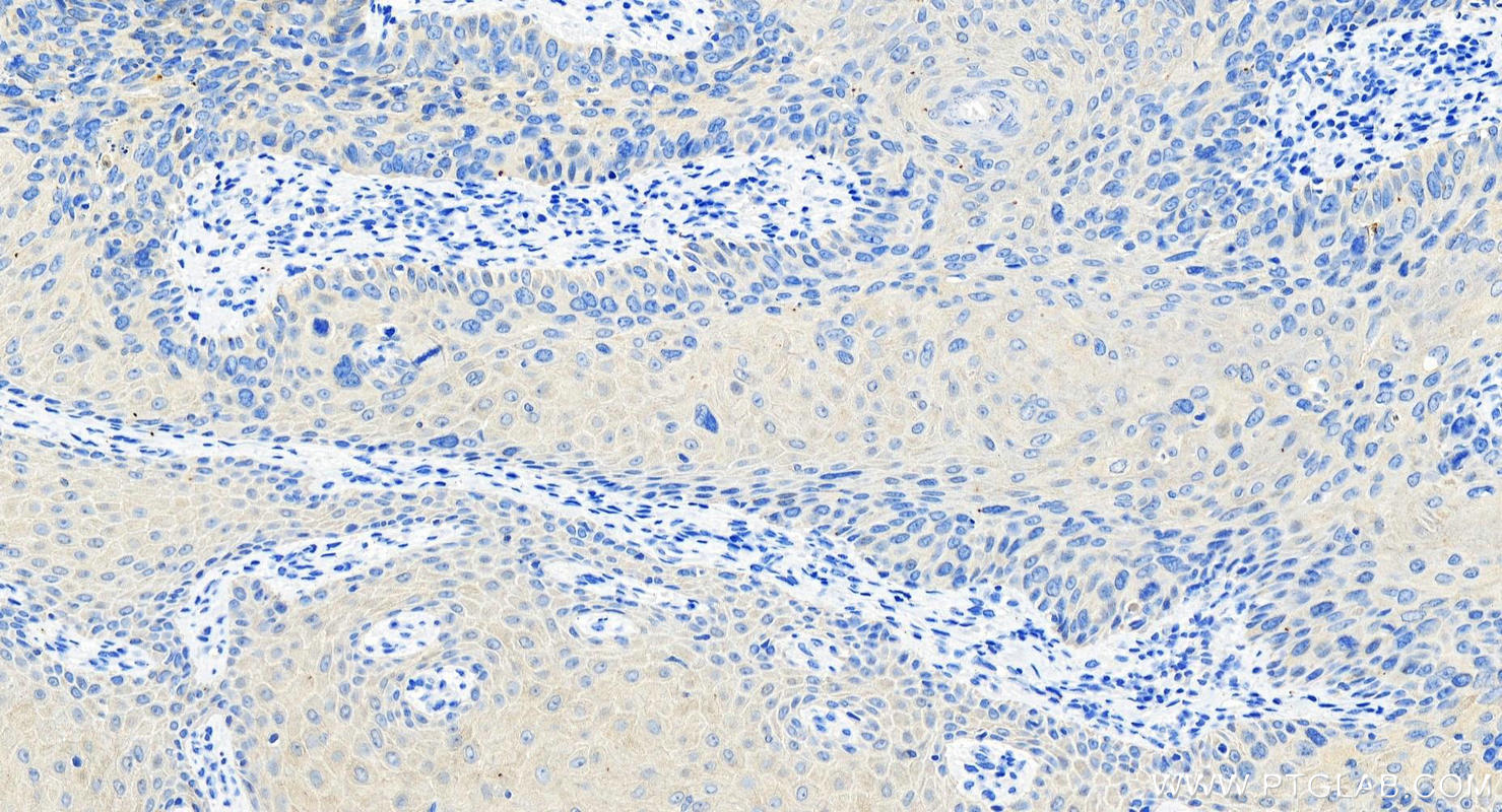 Immunohistochemistry (IHC) staining of human bowen disease using Cytokeratin 8 Polyclonal antibody (10384-1-AP)