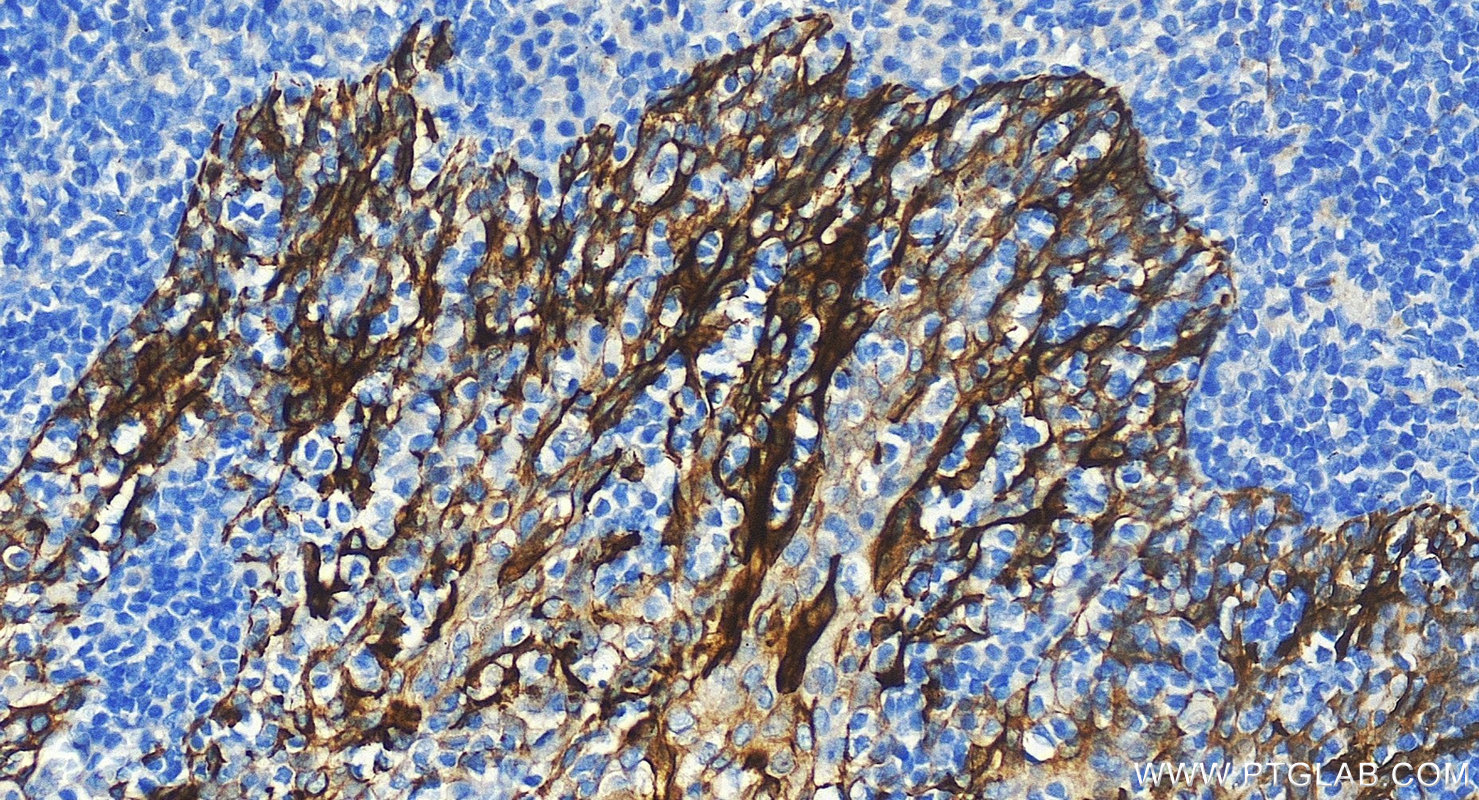 Immunohistochemistry (IHC) staining of human tonsillitis tissue using Cytokeratin 8 Polyclonal antibody (10384-1-AP)