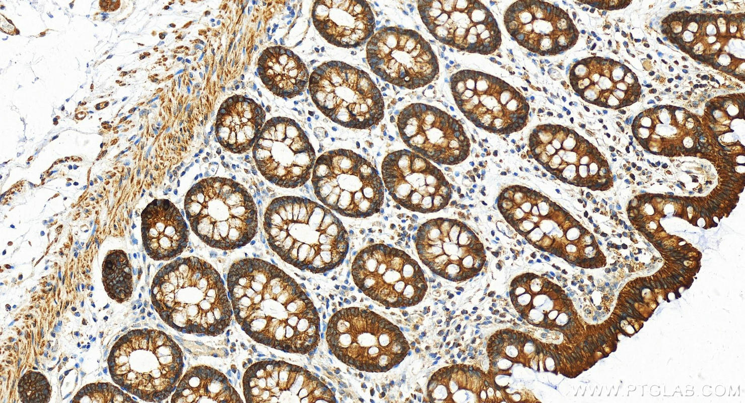 Immunohistochemistry (IHC) staining of human  colon using Cytokeratin 8 Polyclonal antibody (17514-1-AP)