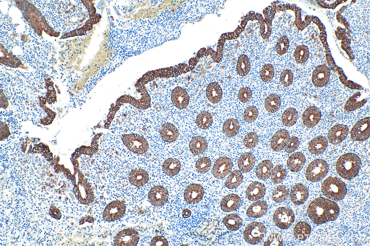 Immunohistochemistry (IHC) staining of human appendicitis tissue using Cytokeratin 8 Polyclonal antibody (17514-1-AP)