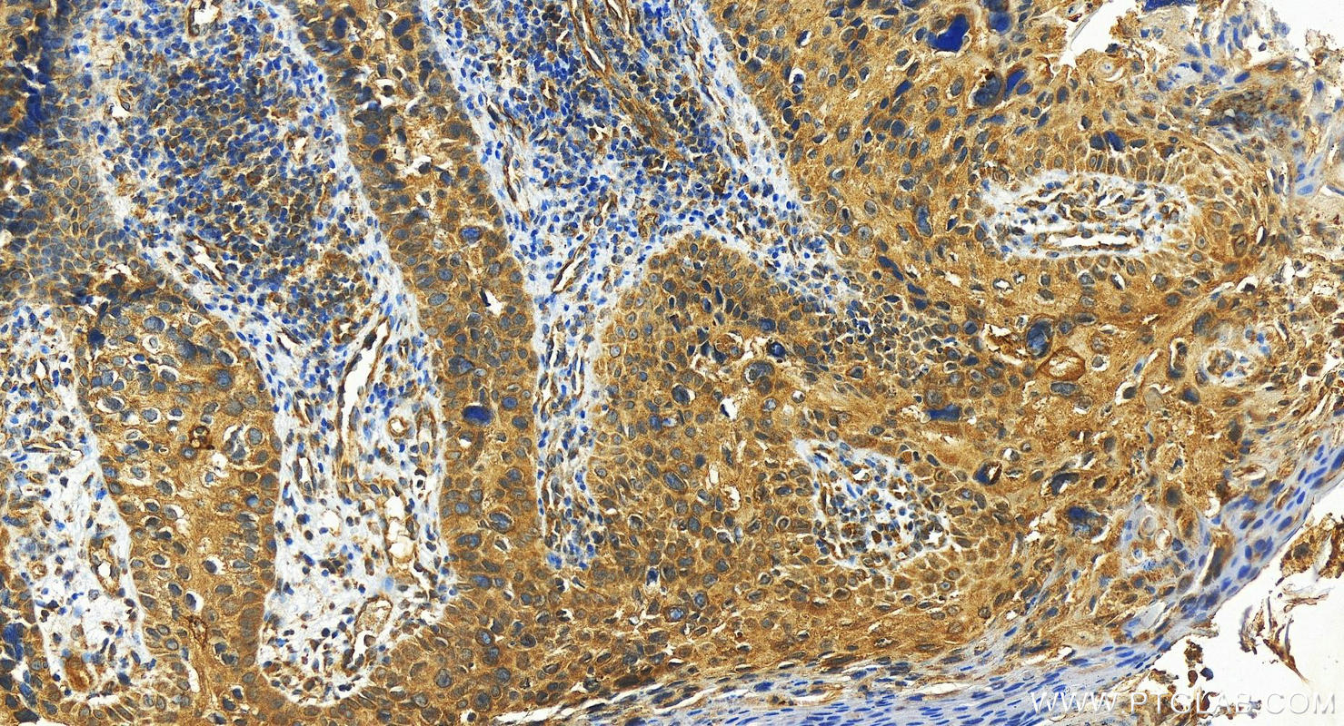 Immunohistochemistry (IHC) staining of human bowen disease using Cytokeratin 8 Polyclonal antibody (17514-1-AP)