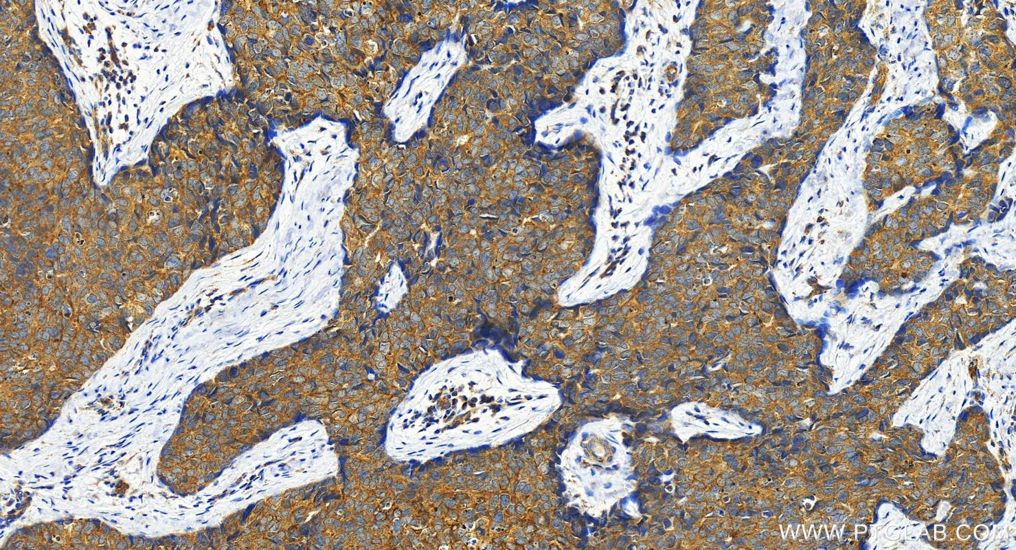 Immunohistochemistry (IHC) staining of human bowen disease using Cytokeratin 8 Polyclonal antibody (17514-1-AP)