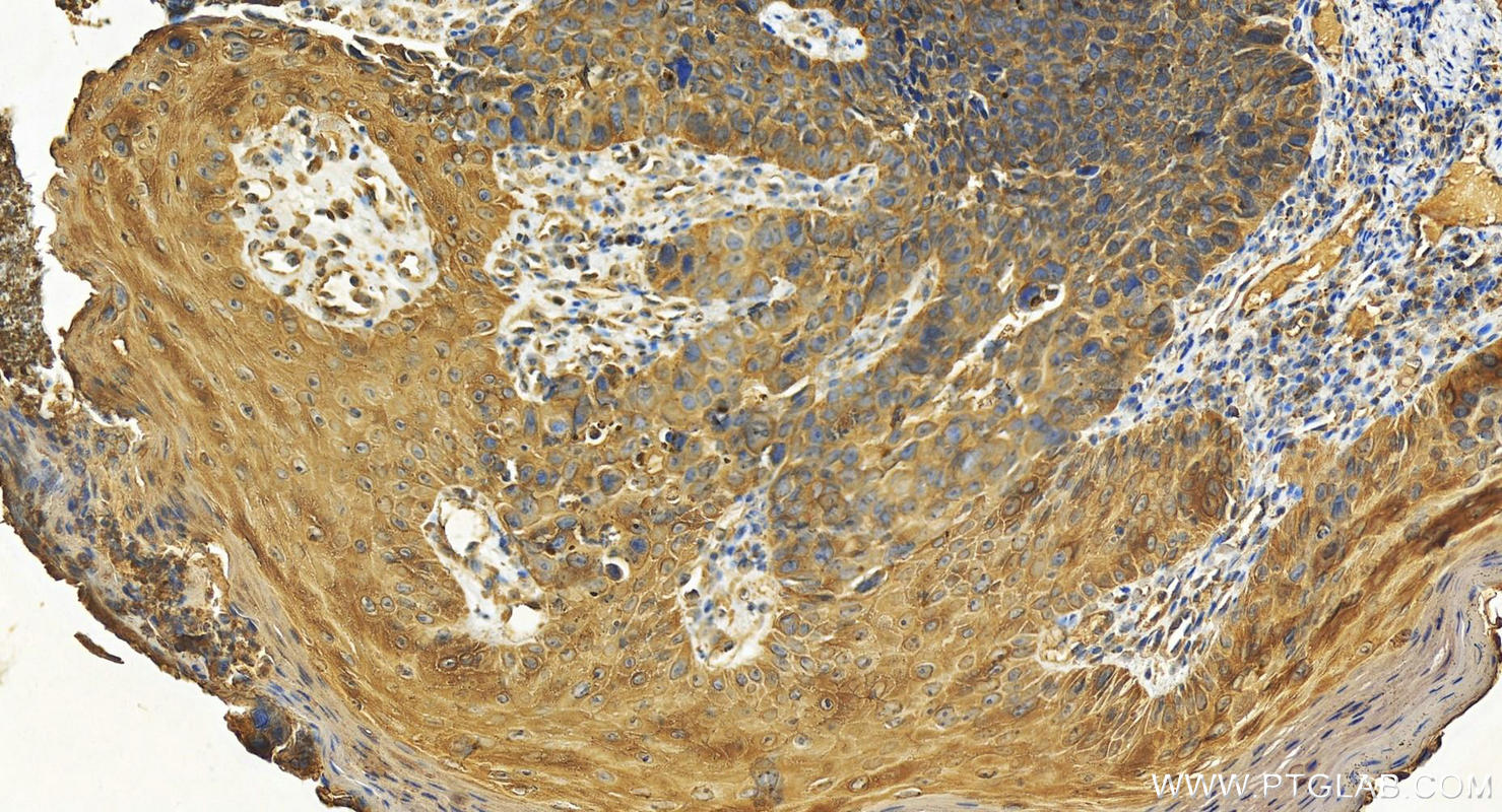 Immunohistochemistry (IHC) staining of human bowen disease using Cytokeratin 8 Polyclonal antibody (17514-1-AP)