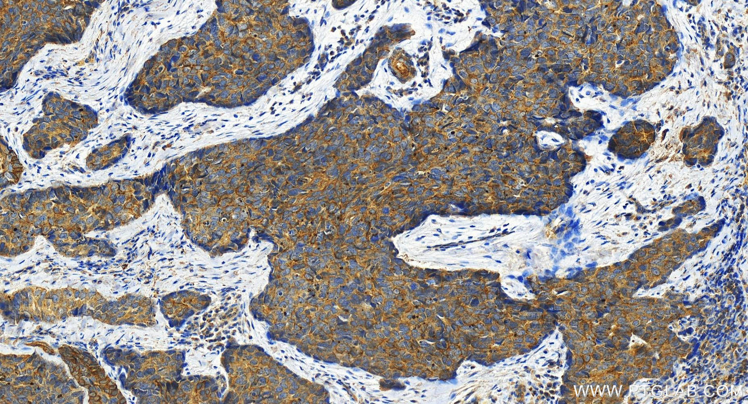 Immunohistochemistry (IHC) staining of human bowen disease using Cytokeratin 8 Polyclonal antibody (17514-1-AP)